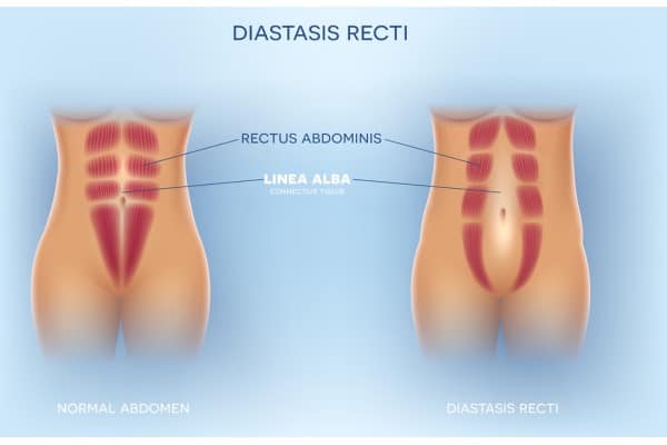 How Does Non-Surgical Treatment Help With Loose Skin, Weak Abdominal Muscles and Post-Pregnancy Changes Windlesham?