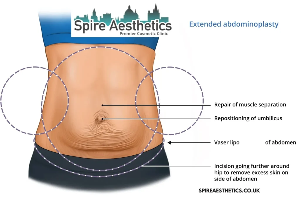Understanding Loose Skin After Gastric Band Windlesham Surgery and HIFU Treatment