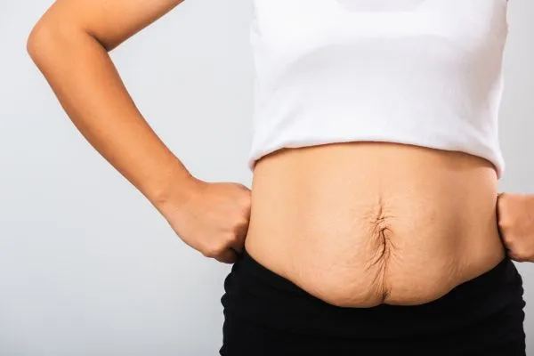 Image of a woman's stomach after weight loss with sagging skin following a gastric band Windlesham