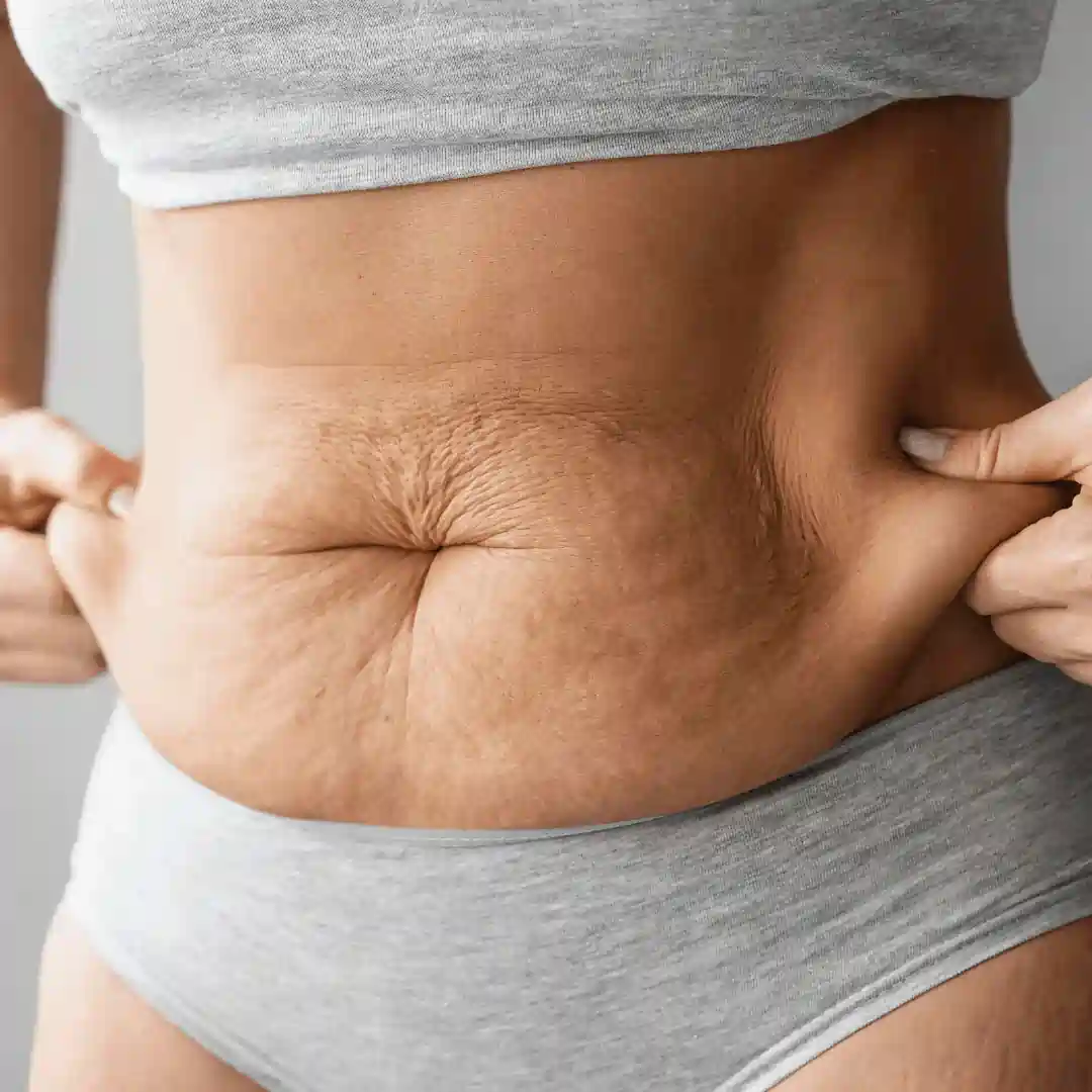 Is It Normal to Have Loose Skin After Pregnancy Windlesham?