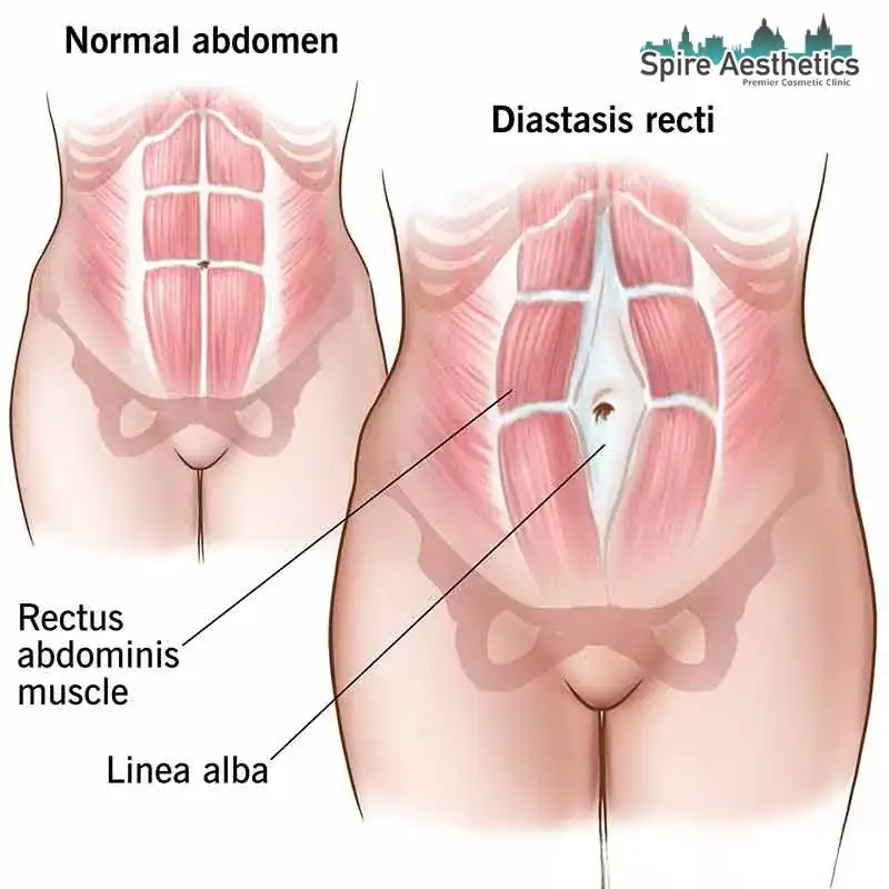 When Will My Belly Feel Normal Again Windlesham?