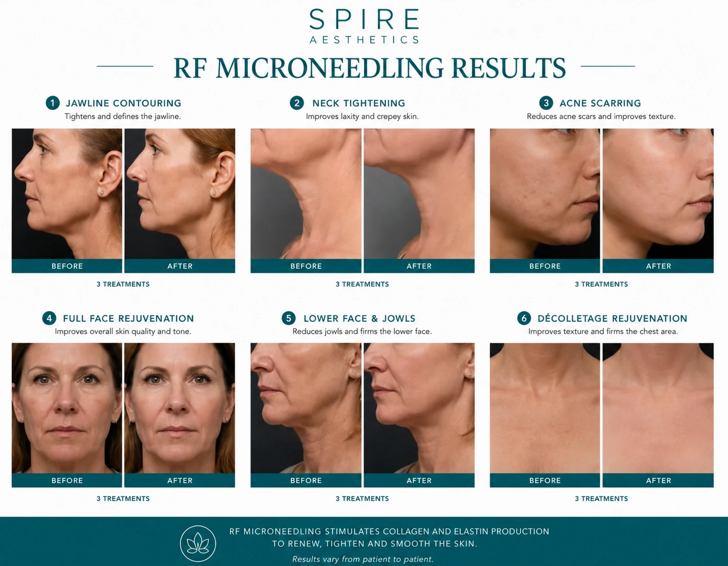 RF Microneedling Skin tightening Windlesham results