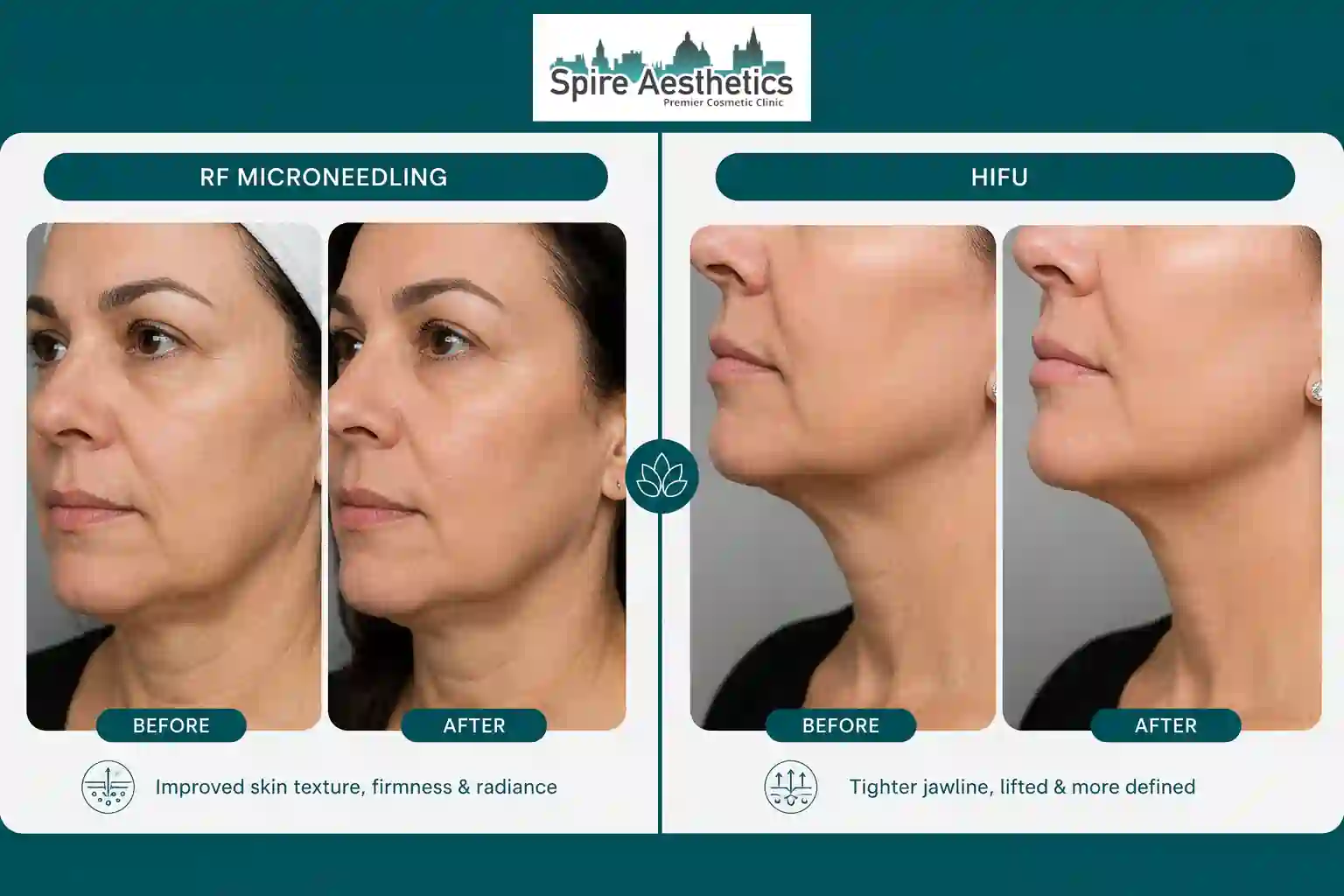 Can RF Microneedling and HIFU Be Combined Windlesham?