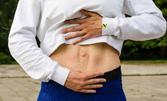 When Could Diastasis Recti Be the Missing Piece of the Puzzle Windlesham?