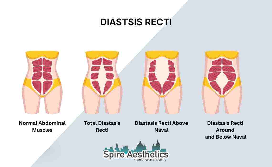 Is Non-Surgical Diastasis Recti Treatment Right for You? Common Concerns Answered Windlesham